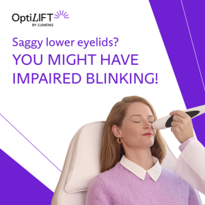 OptiLift RF and Deep Muscle Stimulation treatment